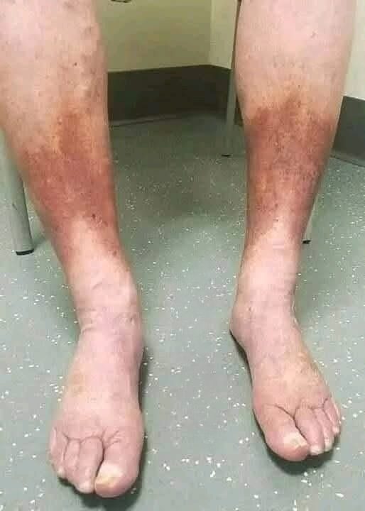 Swollen Feet: What Your Body May Be Trying to Tell You