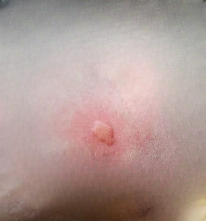 Here’s Why Mosquitoes Seem to Bite Some People More Than Others
