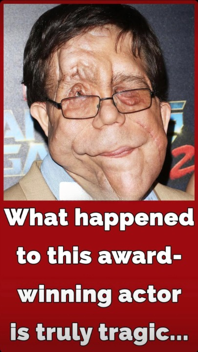 The Inspiring Journey of Adam Pearson: The Actor Who Refused to Be Defined by His Condition