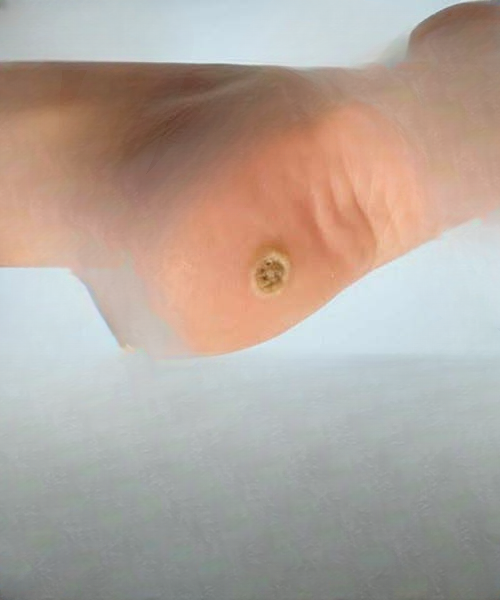 Understanding Plantar Warts on the Feet: How They Differ From Calluses and Why Proper Care Matters