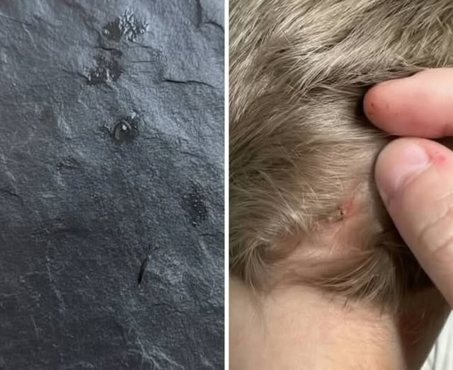 A Tiny Intruder in Your Child’s Hair? Here’s What Every Parent Needs to Know