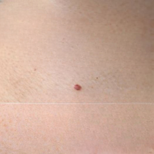 Understanding Red Spots on the Skin: Causes, Meanings, and When to Seek Advice