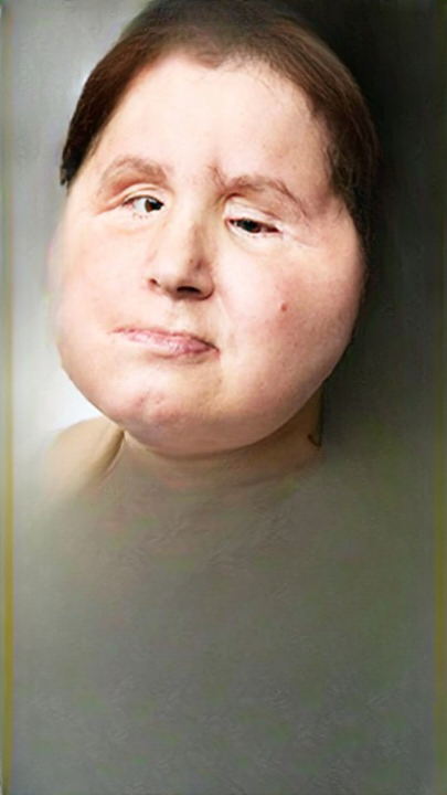 Katie Stubblefield: The Youngest Face Transplant Patient Who Defied the Odds