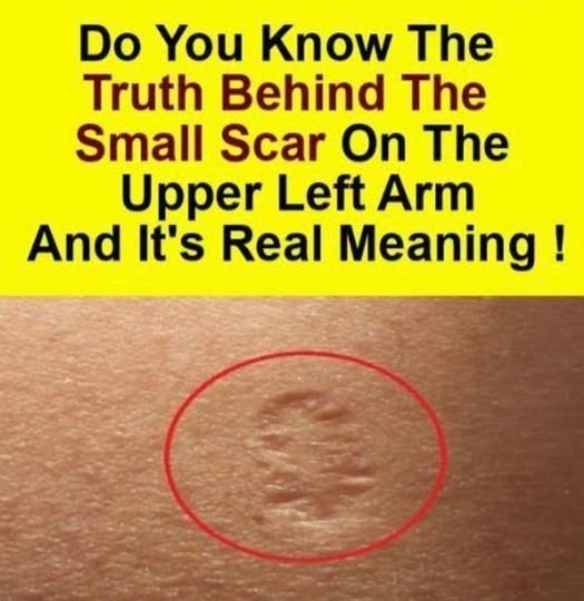The Story Behind the Smallpox Vaccine Scar: History, Science, and Lasting Meaning