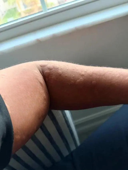 Unexpected Itchy Skin Spots After Contact: What Could Be Happening?