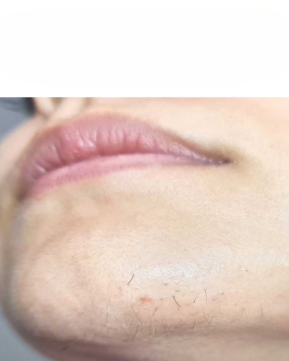 Noticing Chin Hair? Here’s What It Can Mean and Why It’s More Common Than You Think