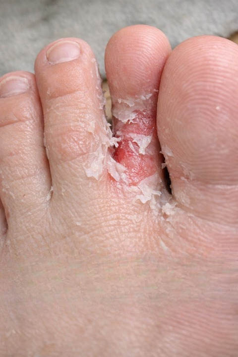 Peeling Skin and Burning Between Toes in Teens: What It Means and How to Handle It Fast
