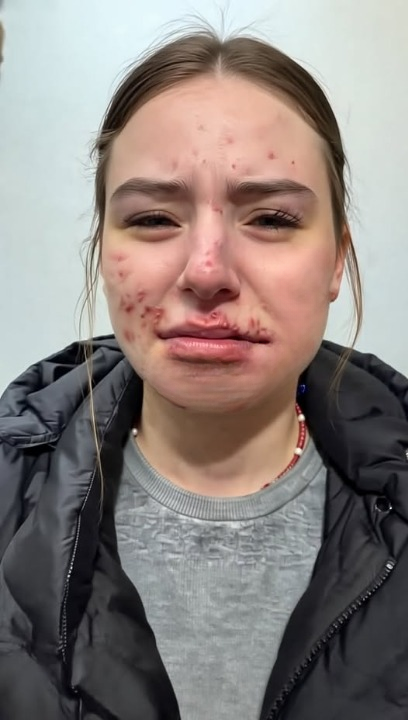 The Hidden Causes of Persistent Chin Acne in Adults: How Hormones, Diet, Stress, and Daily Habits Contribute to Breakouts and the Most Effective Ways to Manage and Prevent Them