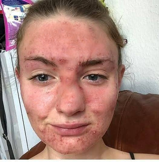 She Thought It Was Just an Allergy—But the Reality Was Much More Serious
