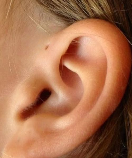 The Small Opening Near the Ear: Understanding a Unique and Harmless Human Trait