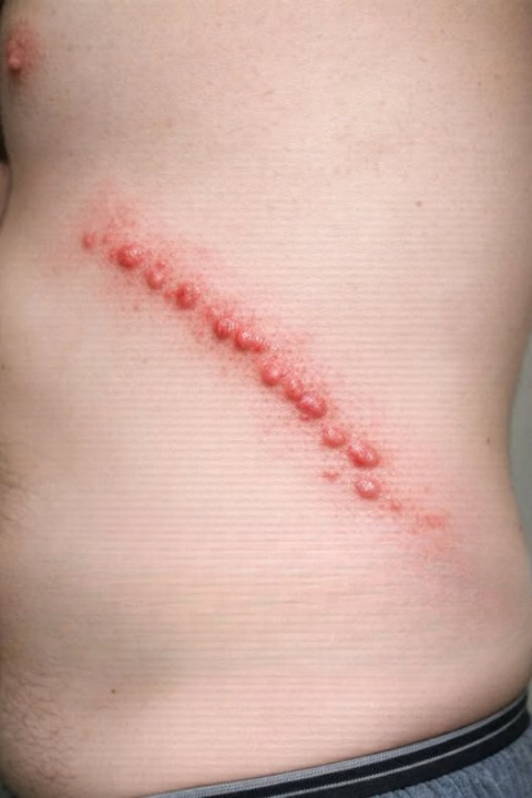 Red, Itchy Bumps in Lines on the Skin: Possible Causes, What to Look For, and How to Respond Safely