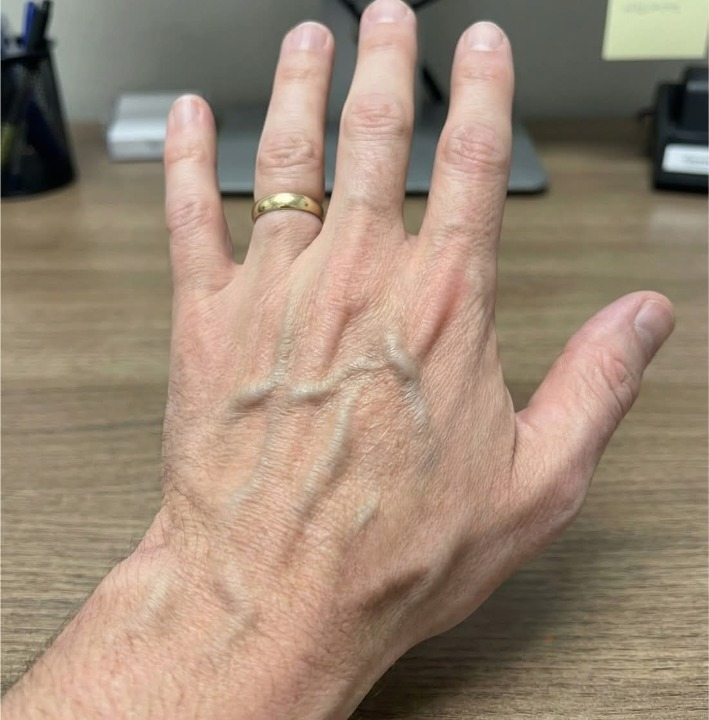 What Do Visible Veins Really Mean? Understanding Your Body Beyond the Myths
