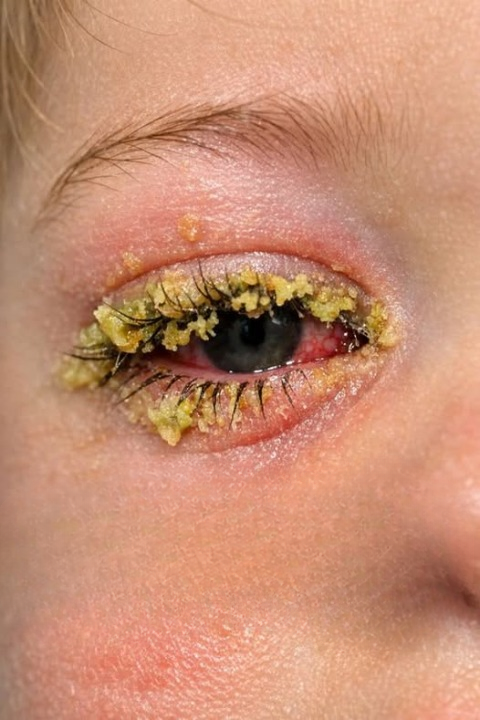 Toddler Woke Up With Eye Glued Shut? Here’s How to Clean It Safely and What to Watch For