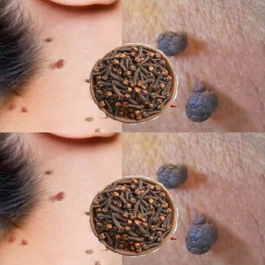 Cloves for Skin Care: What You Should Know Before Trying Natural Remedies for Skin Tags and Warts