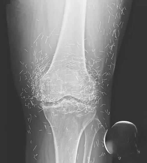 Hidden Gold Needles in a Patient’s Knee — A Medical Case That Sparked Debate About Alternative Treatments and Long-Term Safety