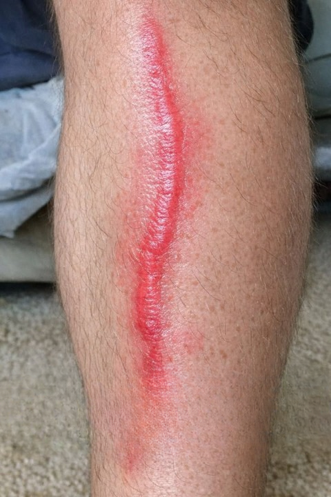 A Sudden Red Line on the Leg: What It Might Mean and When to Seek Medical Attention