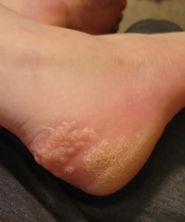 A Parent’s Concern: What Could Cause Yellow Bumps on a Child’s Feet After Sharing Shoes?