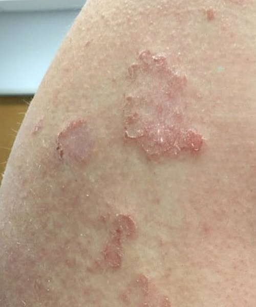 Red Marks on the Skin: Common Causes, Meanings, and When to Pay Attention