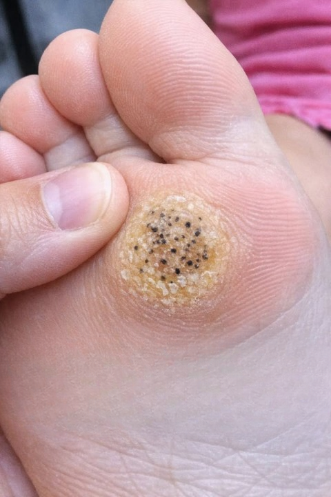 Painful Spot on Your Child’s Foot Before an Important Event? Here’s What You Should Know and Do