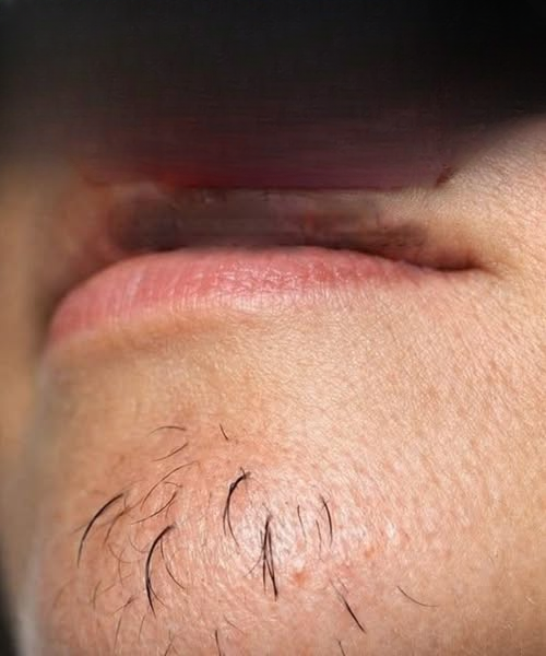 Chin Hair in Women: What It Means, Why It Happens, and When It’s Normal