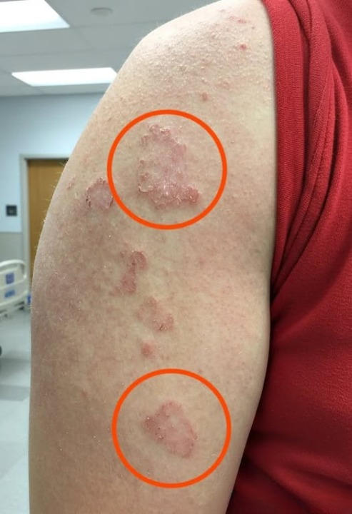 Understanding Circular Skin Rashes: What That Ring-Shaped Mark Might Mean