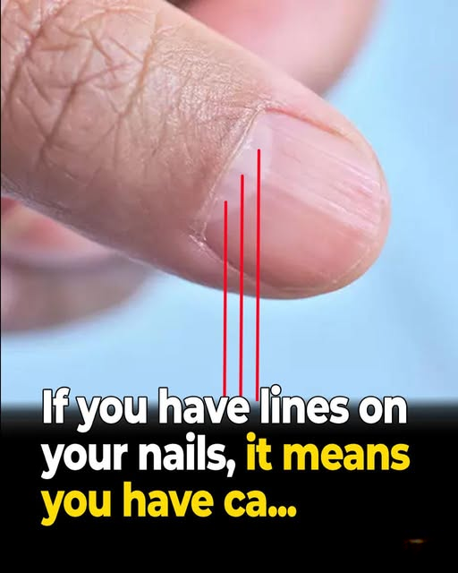 What Vertical Ridges on Your Fingernails May Indicate — Especially After 40