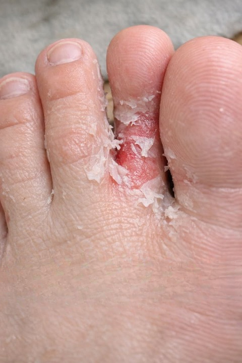 My Teen Son Showed Me His Feet—The Skin Between His Toes Was Peeling: What It Could Mean and How to Handle It Safely