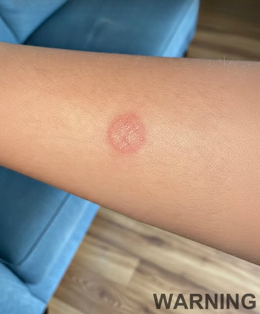 Early Signs of Common Skin Fungal Infections: What to Watch For and How to Respond