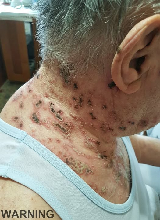 Shingles Explained: Why a Past Chickenpox Infection Can Return Years Later
