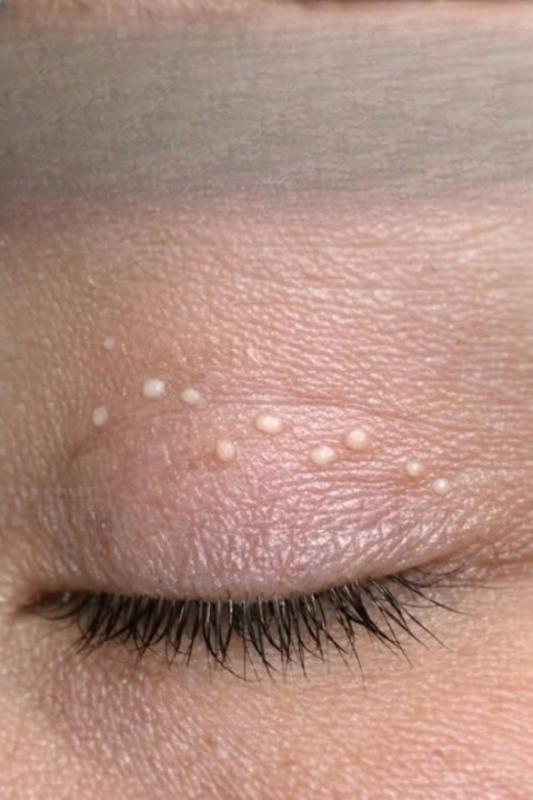 Tiny white bumps keep appearing on my eyelids, and I haven’t been able to see a doctor yet—what could they be?”