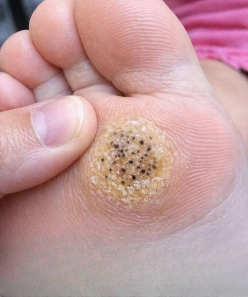 A Painful Spot on Your Child’s Foot Before a Dance Recital: What You Can Do Quickly and Safely