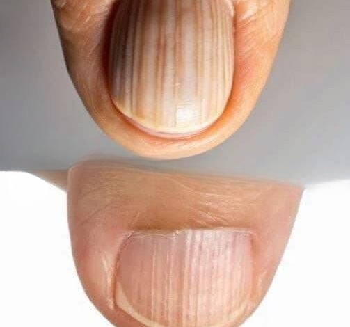 What Those Strange Lines on Your Fingernails Could Be Telling You About Your Health — And When You Should Pay Closer Attention
