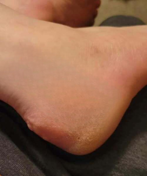 My 9-Year-Old Started Wearing Another Child’s Shoes — Then These Yellow Bumps Appeared. What Could It Be?
