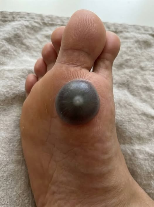 My Daughter Woke Up With a Painful Spot on Her Foot—What Could It Be? Understanding Possible Causes and What to Do