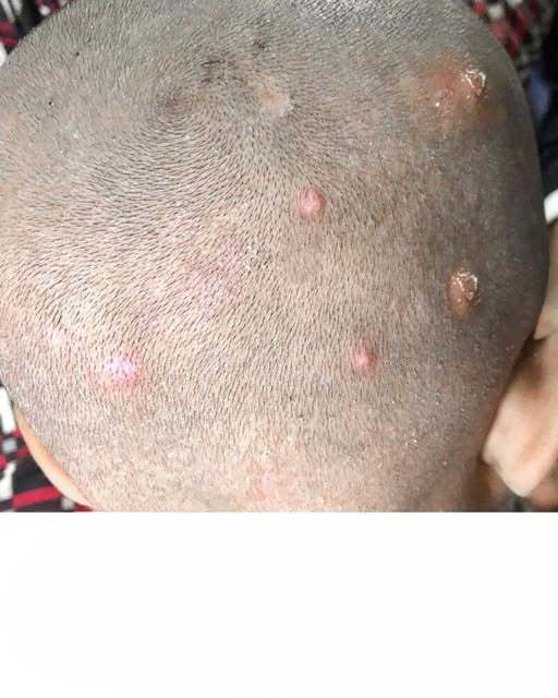 I Found Painful Bumps on My Son’s Scalp — Our Doctor Visit Is Still Days Away. What Can I Do in the Meantime?