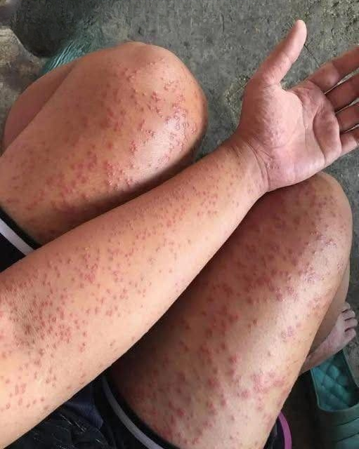 Why Sudden Itchy Red Welts Combined With Breathing Trouble Should Never Be Ignored — Understanding the Warning Signs of a Severe Allergic Reaction