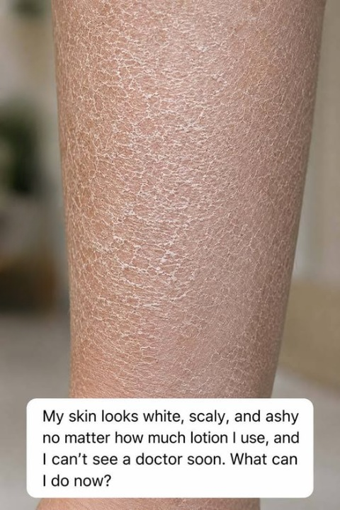 Why Your Skin Still Looks Ashy and Dry Even After Using Expensive Lotion — And the Real Reason Moisturizers Sometimes Fail