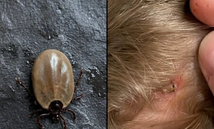 Parents Urged to Stay Alert After Tick Discovery Highlights Importance of Early Detection and Safe Removal