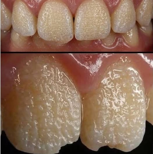 The Hidden Dental Condition That Could Be Weakening Your Teeth Without You Realizing It