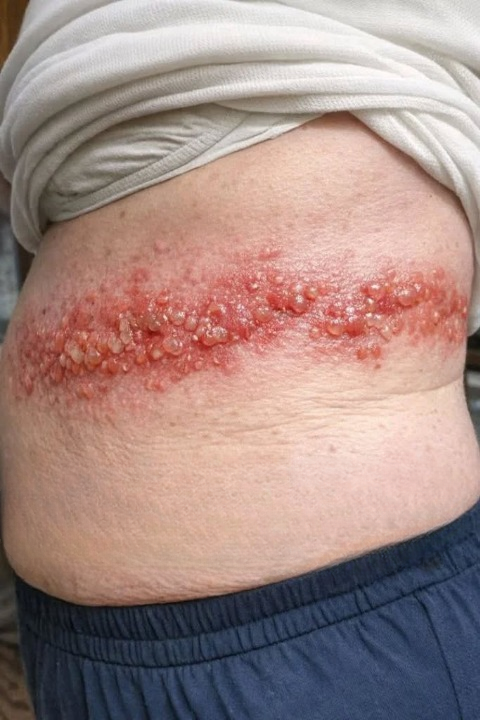A Painful Rash Appeared Along My Mother’s Side — While Waiting for Medical Advice, We Learned the Importance of Paying Attention to Symptoms