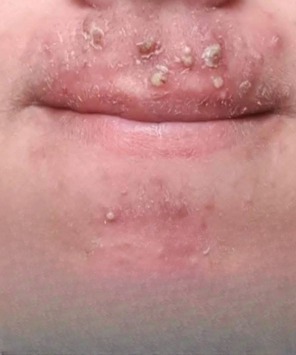 Rash Around the Mouth: Common Causes, Skin Care Tips, and When to See a Doctor