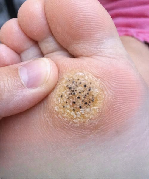 My Daughter Has a Painful Spot on Her Foot Before Her Dance Recital — What Can Parents Do Quickly and Safely?
