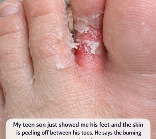 My Teen Son Complained About Burning, Peeling Feet Before Sports Practice — What We Learned Helped More Than We Expected
