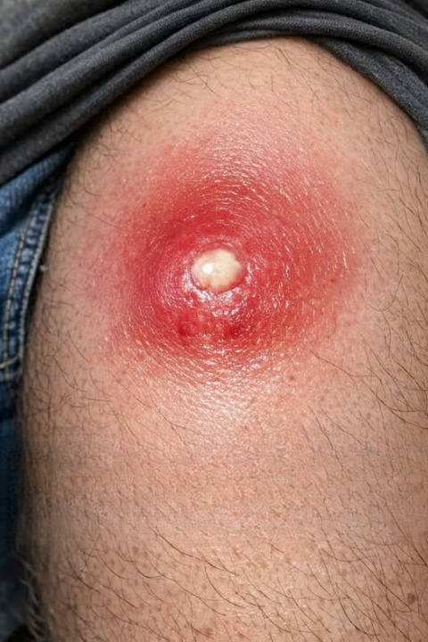 A Painful Red Lump Appeared on My Husband’s Thigh — Here’s Why It’s Important Not to Panic and What Steps to Take
