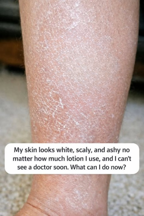 My Skin Looks Dry, Ashy, and Flaky No Matter How Much Lotion I Use: Practical Steps You Can Try While Waiting to See a Healthcare Professional